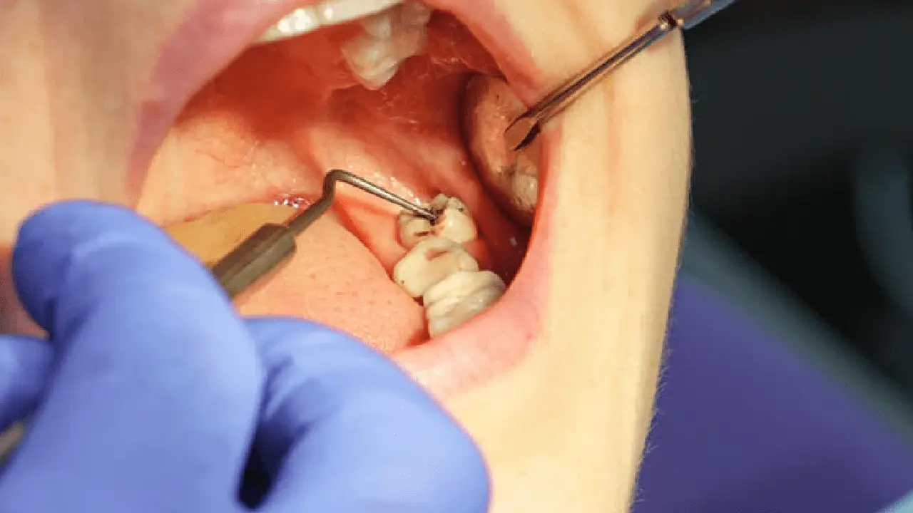 Wisdom Tooth Removal